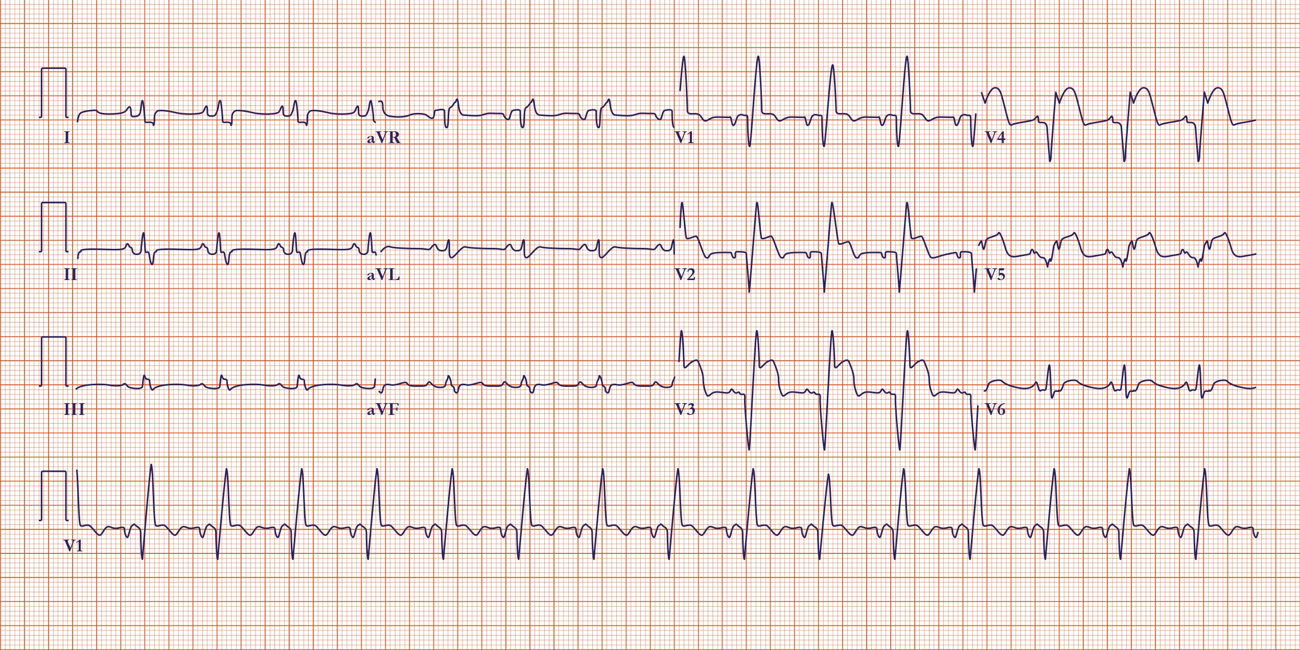 ECGs in Acute Myocardial Infarction | ACLS Training