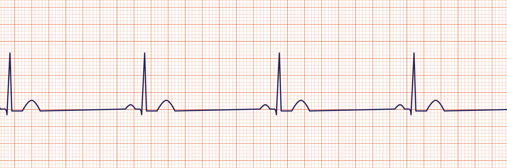 ACLS-Figure-23