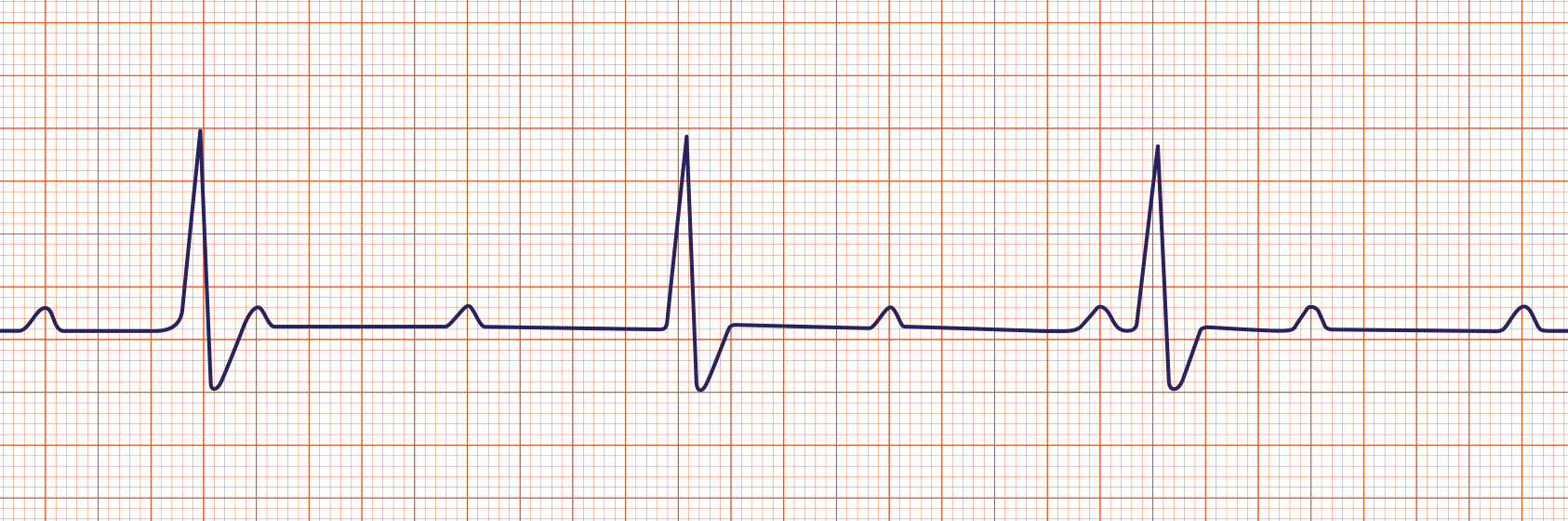 ACLS-Figure-28