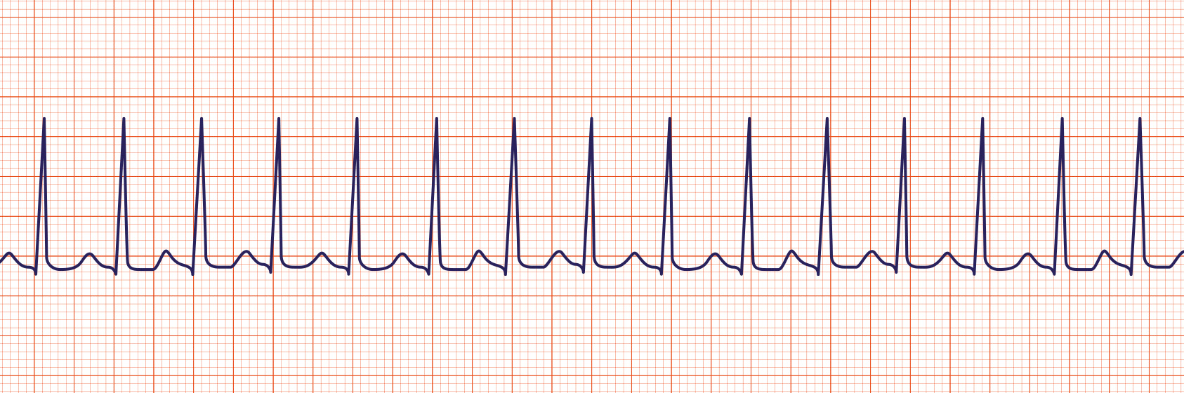 ACLS-Figure-29