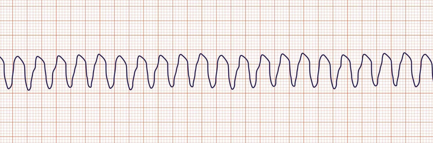 ACLS-Figure-32