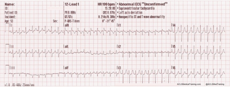 Initial 12-lead ECG showing regular narrow-complex supraventricular tachycardia