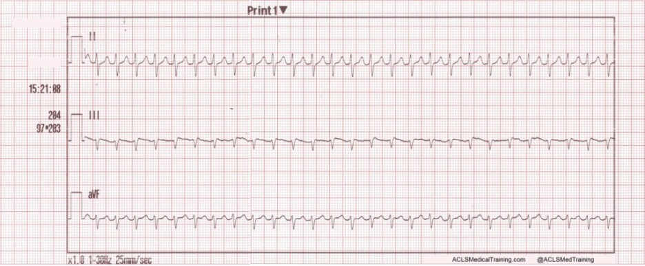 Rhythm strip showing regular narrow-complex supraventricular tachycardia