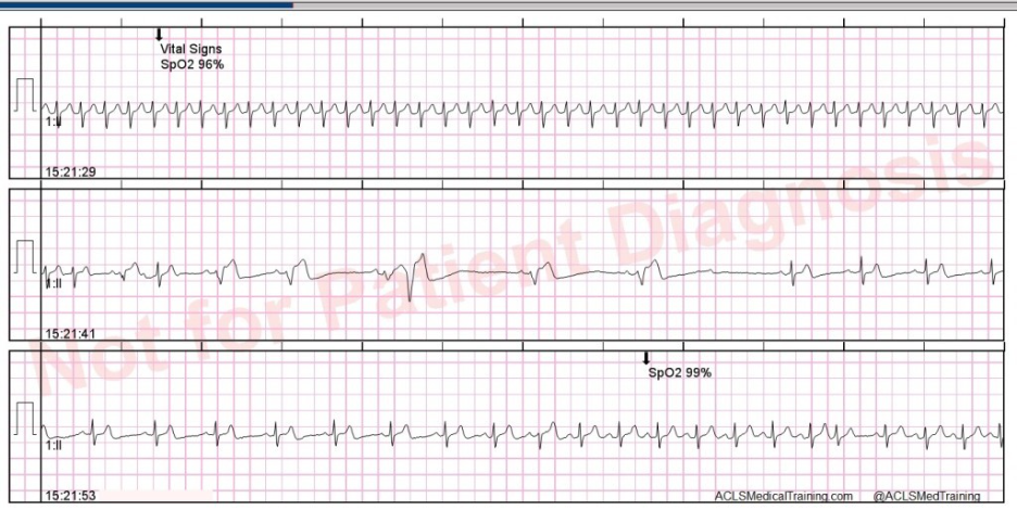 ECG monitor showing transient rhythm changes after adenosine administration for SVT