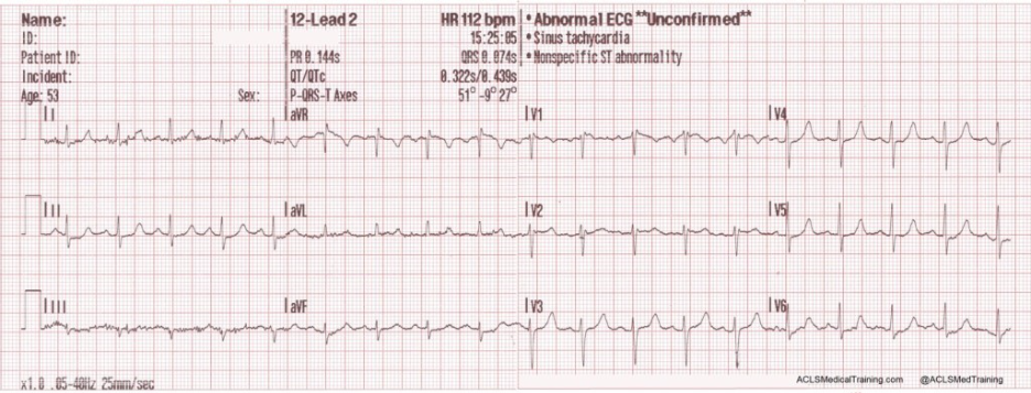 Post-conversion 12-lead ECG showing sinus rhythm after adenosine treatment for SVT