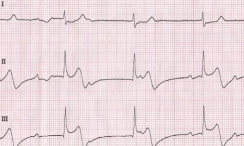 Syncope with Acute Inferior STEMI and 3 Different AV Blocks