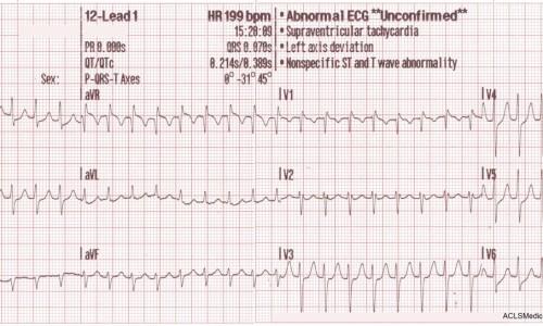Treating Supraventricular Tachycardia with Adenosine