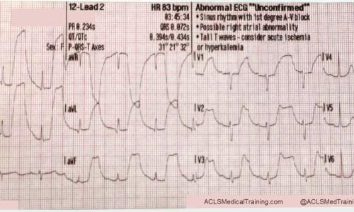Guide to Understanding ECG Artifact