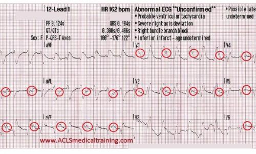 Wide Complex Tachycardia Treated With Amiodarone and Synchronized Cardioversion