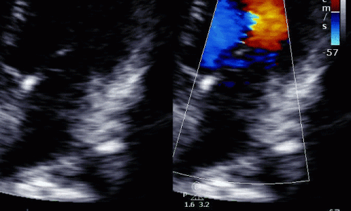 Mechanical Complications of STEMI