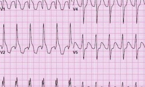 Cocaine Overdose Presents with Wide Complex Tachycardia