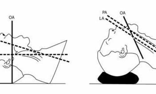 How to Master Tracheal Intubation