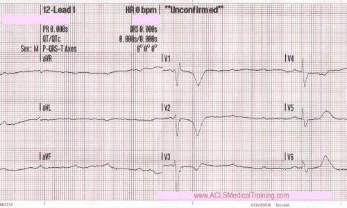 Unstable Bradycardia Resolves Following Atropine and Attempted Transcutaneous Pacing (TCP)