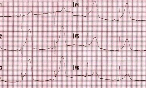Chest Pain and Transient ST-Segment Elevation