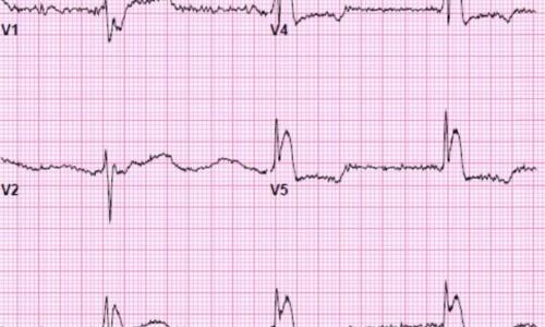 55 year old male with altered mental status, hypothermia, and Osborn waves