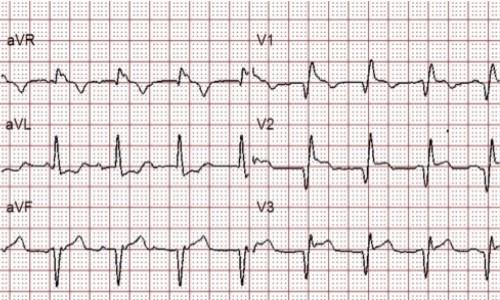 Shock, ST-Segment Elevation, and Massive Pulmonary Embolism