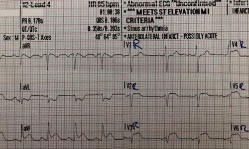Acute Inferior STEMI with Right Ventricular Infarction and Cardiac Arrest