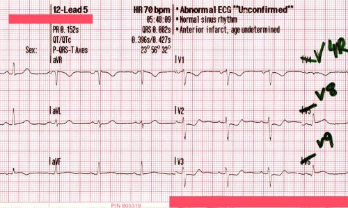 Posterior STEMI and Prehospital Tenecteplase (TNK)