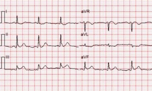 Cardiac Cath Lab Activation for Subtle Acute Inferior STEMI
