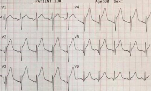 ST-Segment Elevation in Elderly Patient Following Smoke Inhalation