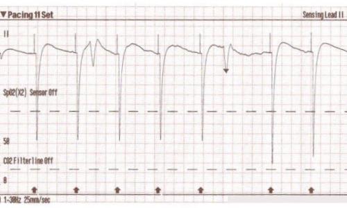 Transcutaneous Pacing (TCP) With and Without Capture