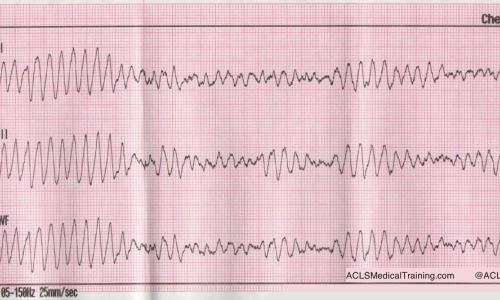 CPR First? Or Defibrillation First?