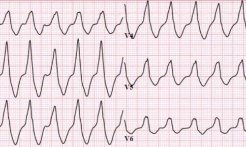 Myths and Cognitive Biases in Interpretation of Wide Complex Tachycardias