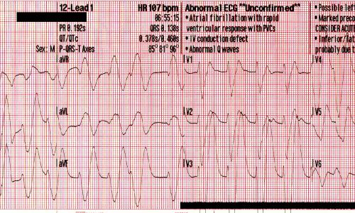 Mixed Overdose and Na-Channel Blockade