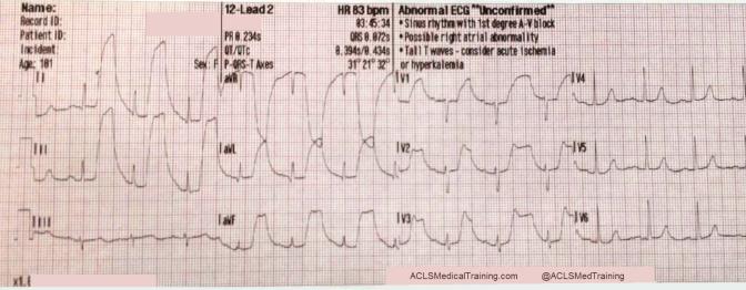 Guide to Understanding ECG Artifact