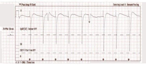 Transcutaneous Pacing (TCP) With and Without Capture