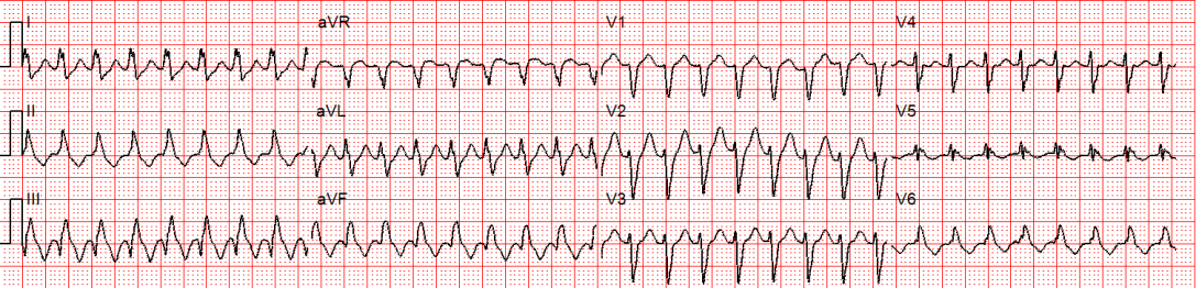 SVT with Aberrancy or Ventricular Tachycardia