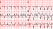 SVT with Aberrancy or Ventricular Tachycardia