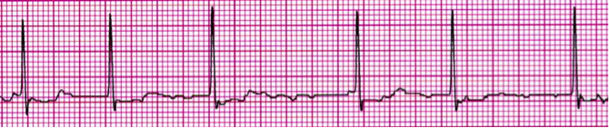 afib flutter afib flutter