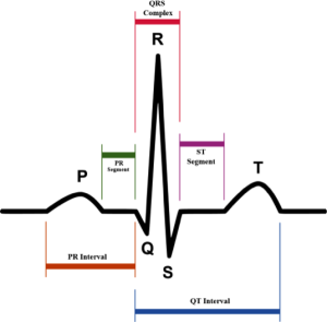 Arrhythmia Recognition Chart