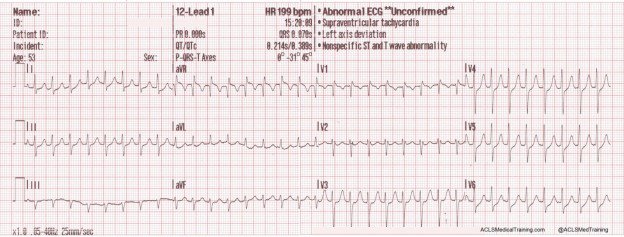Rhythm Popularity - ACLS Professional medical Performing exercises photograph about Ekg Practice Strips Printable titled Rhythm Reputation - ACLS Health care Doing exercises