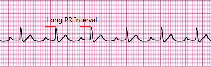 Arrhythmia Recognition Chart