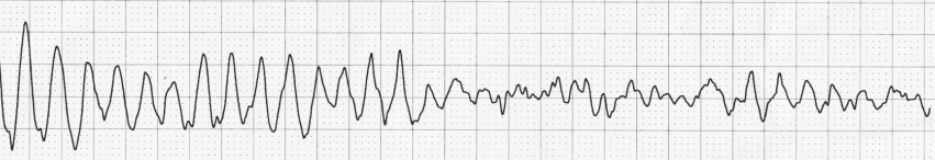 Types Of Arrhythmia Chart