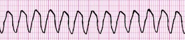 Arrhythmia Recognition Chart