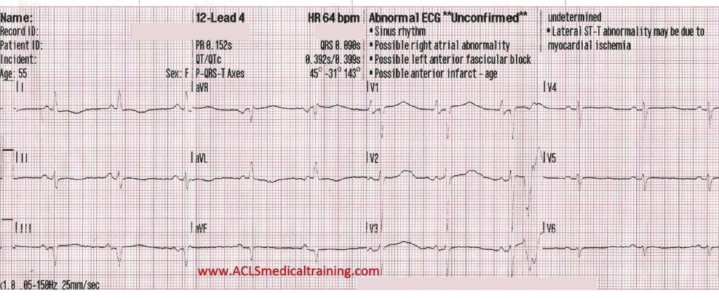 12-Lead 4 ECG