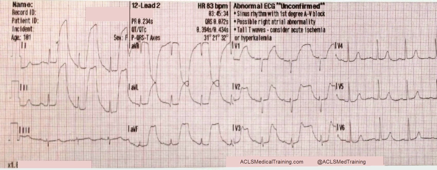 Telemetry Heart Rate Chart