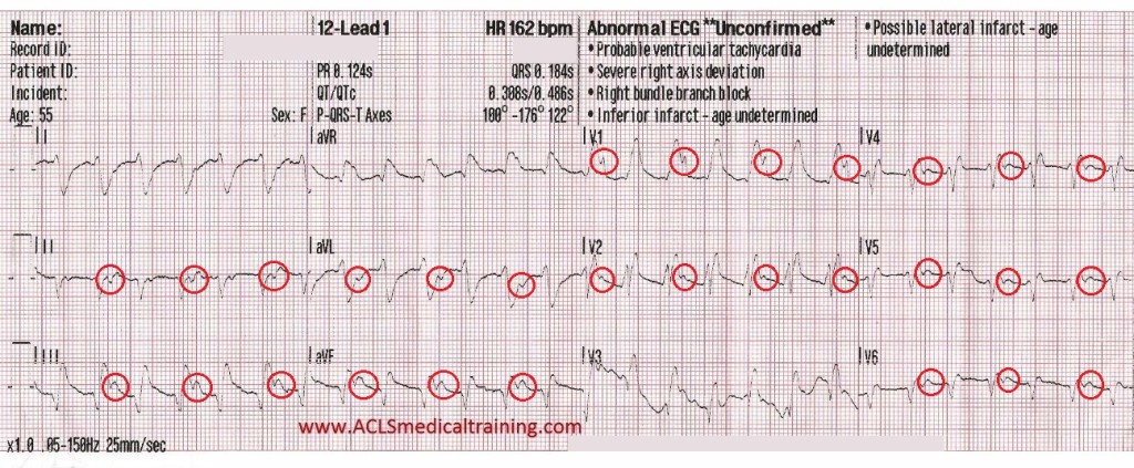 ECG with highlighted points