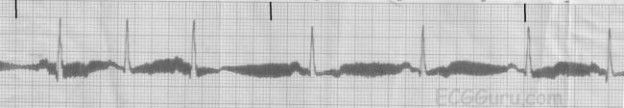 Types of ECG Artifacts | Understanding Interference
