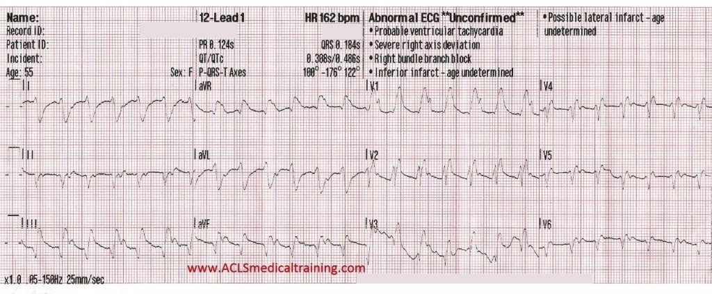 Initial 12-Lead ECG