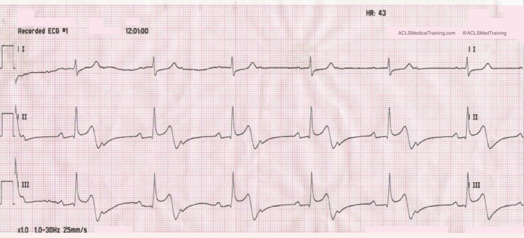 Recorded ECG #1