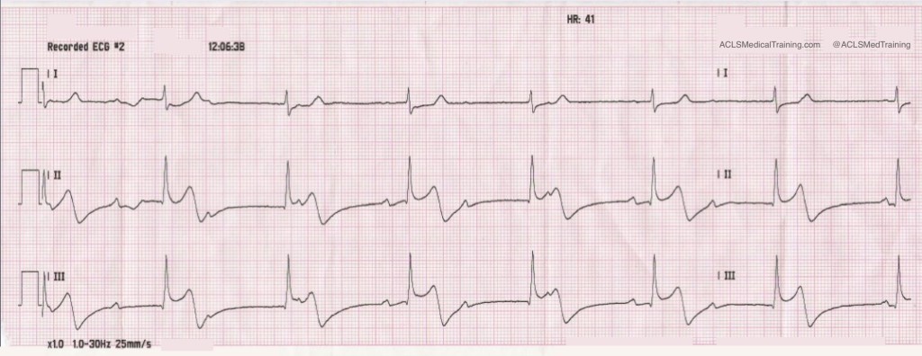 Recorded ECG #2