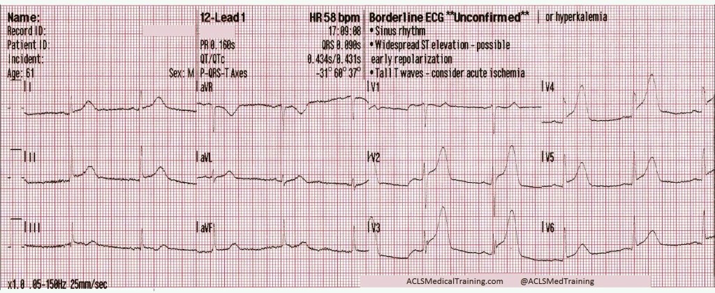 ST-segment elevation