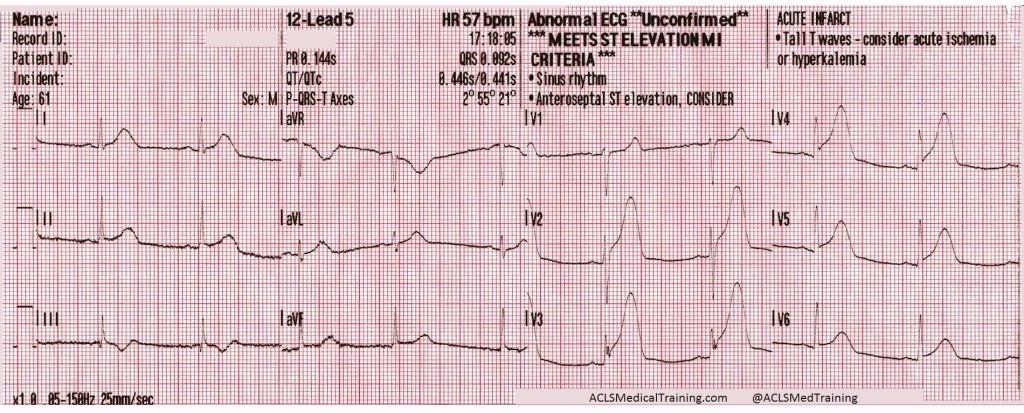 ST-segment elevation returns