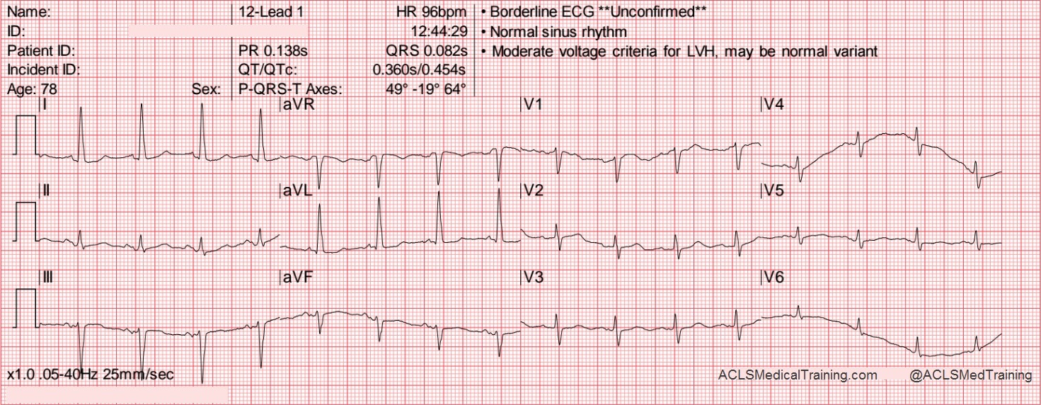 Is Borderline ECG Dangerous? Understanding Your ECG Reports