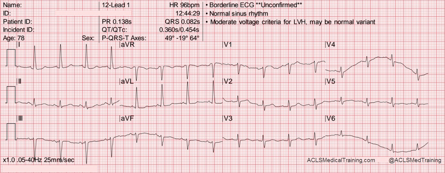 what is baseline wandering in ecg