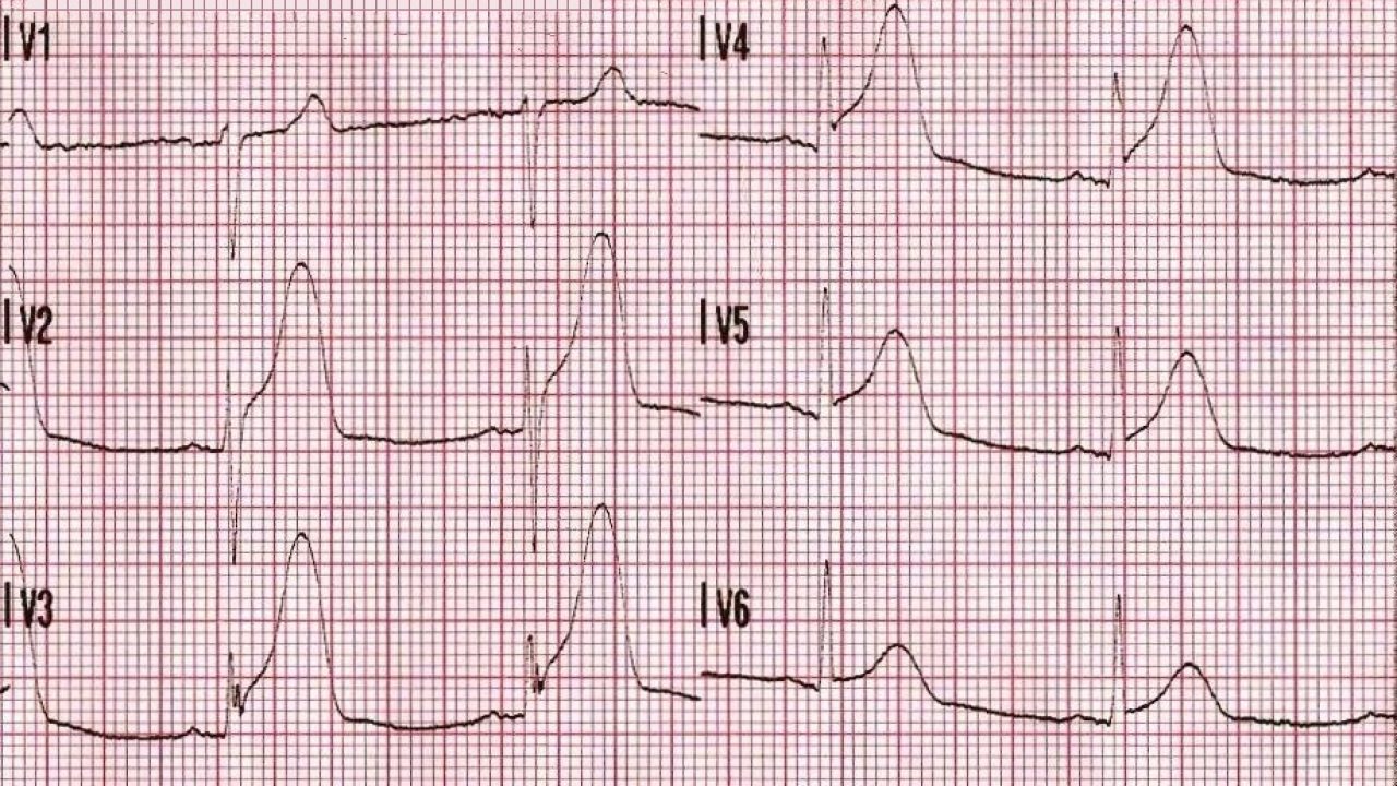 Chest Pain And Transient St Segment Elevation Acls Medical Training Chest Pain And Transient St Segment Elevation Acls Medical Training
